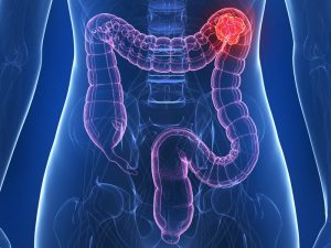Image for Can Prolonged Antibiotic Use Lead to Colon Cancer?